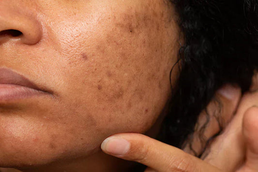 Best Vitamin C for Dark Spots After 50 (What Actually Works)